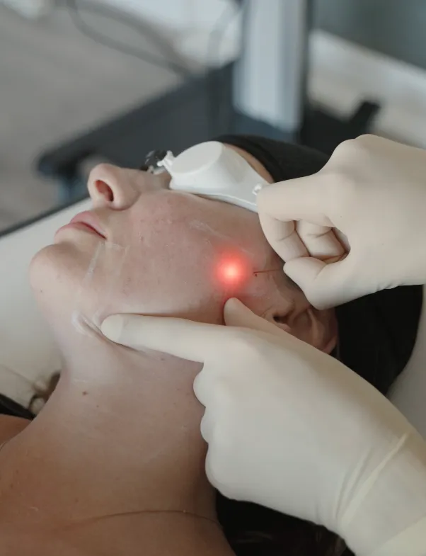 Endolift Laser